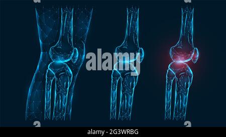 Polygonale Vektordarstellung Seitenansicht Oberschenkel- und Kniegelenk. Krankheit, Schmerzen und Entzündung des Kniegelenks. Low-Poly-Modell Stockfoto