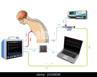 Medizinisches Poster mit menschlicher Wirbelsäule und Spritzennadel, die in den Spinalkanal eingeführt wurde, um Cerebrospi zu sammeln Stockfoto
