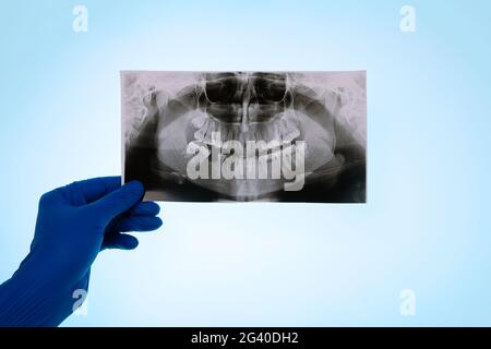 Hand in Hand hält den Zahn des Patienten auf blauem Hintergrund fest und der Arzt analysiert den Ort für das Zahnimplantat Stockfoto