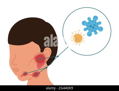 Eine Person mit einer viralen Entzündung der Speicheldrüsen. Vektordarstellung der Sialolithiasis. Stockfoto