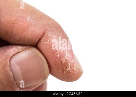 Nahaufnahme von schmerzhaft entzündet geschädigter trockener Haut am Finger Stockfoto