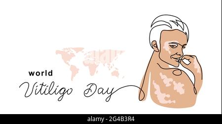 Vitiligo Haut einfache Vektor-Banner, Poster, Hintergrund. Person mit Hautpigmentierung. Eine kontinuierliche Linie Kunst Zeichnung und Beschriftung Welt Vitiligo Stock Vektor