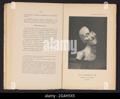 Waschen anatomisches Modell eines Kopfes von Laumonier; Pièce Anatomique and Cire Modelèe Par Laumonier (1749-1818). . Stockfoto