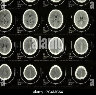 MRT-Hirnuntersuchung Stockfoto
