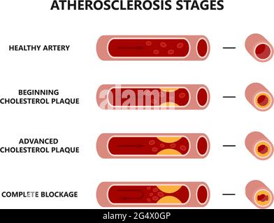 Atherosklerose-Bildung. Gesunde und ungesunde Arterien. Cholesterinplaque in den Blutgefäßen. Stock Vektor