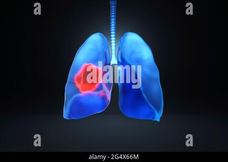 Digital generiertes Bild von krebskranken Lungen Stockfoto
