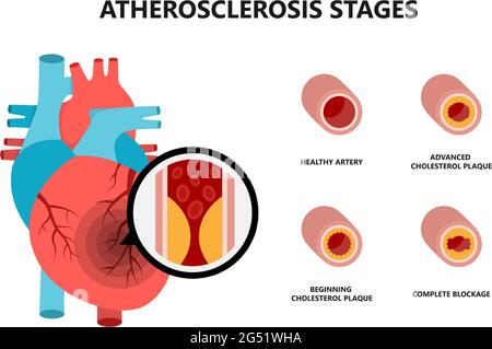 Anatomie des menschlichen Herzens mit atherosklerotischer Plaque. Cholesterinplaque in den Blutgefäßen. Stock Vektor