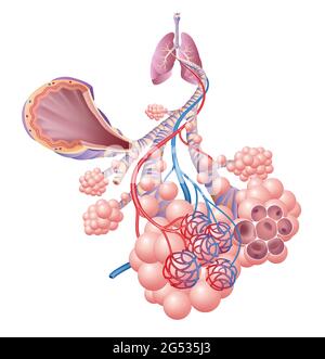 Abbildung zeigt die Entzündung des Bronchus, der Asthma verursacht Stockfoto