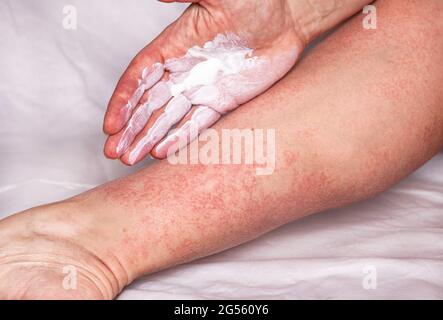 Weie Salbe auf das Palm beruhigende Hautausschlag von einer allergischen  Reaktion. Die Anwendung eines therapeutischen Salbe fr allergische  Hautausschlge auf das Bein. Behandlung von aller Stockfotografie - Alamy