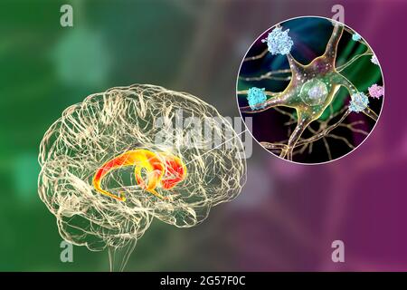 Neuronale Einschlüsse bei der Huntington-Krankheit, Illustration Stockfoto