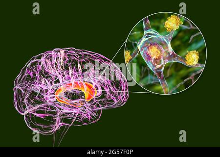 Neuronale Einschlüsse bei der Huntington-Krankheit, Illustration Stockfoto