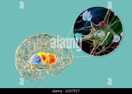 Dorsale Striatum bei der Huntington-Krankheit, Illustration Stockfoto