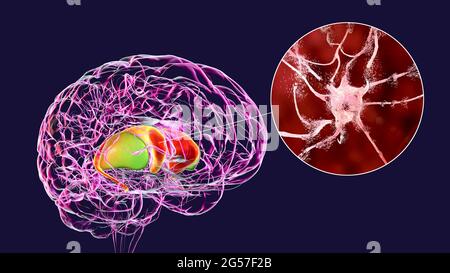 Dorsale Striatum bei der Huntington-Krankheit, Illustration Stockfoto