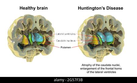 Normales Gehirn und Gehirn bei Morbus Huntington, Illustration Stockfoto