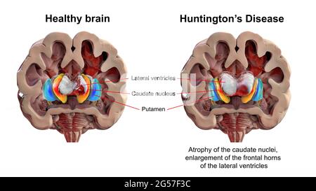 Normales Gehirn und Gehirn bei Morbus Huntington, Illustration Stockfoto