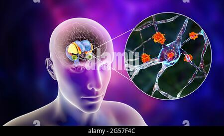 Dorsale Striatum bei der Huntington-Krankheit, Illustration Stockfoto