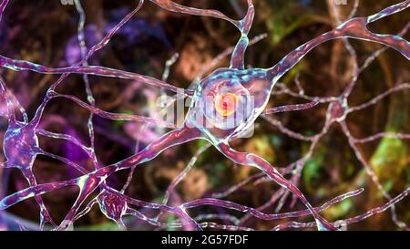 Neuronale Einschlüsse bei der Huntington-Krankheit, Illustration Stockfoto