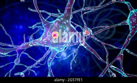 Neuronale Einschlüsse bei der Huntington-Krankheit, Illustration Stockfoto