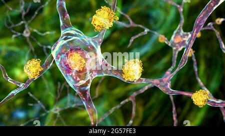 Neuronale Einschlüsse bei der Huntington-Krankheit, Illustration Stockfoto