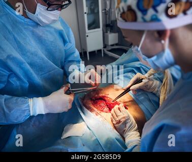 Medizinisches Personal mit sterilen Handschuhen, die plastische chirurgische Eingriffe durchführen. Ärzte tragen chirurgische Uniformen, während sie überschüssiges Fett aus dem Bauch des Patienten im Krankenhaus entfernen. Konzept der Bauchstraffung. Stockfoto