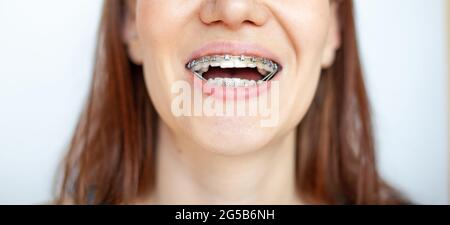 Die Frau lächelt und zeigt ihre weißen und sogar Zähne mit Zahnspangen. Stockfoto