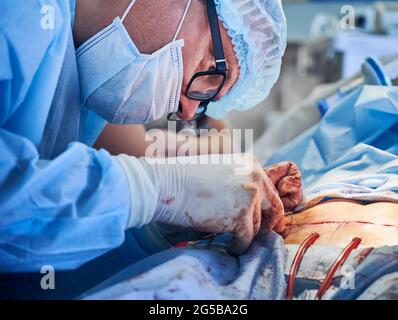 Nahaufnahme eines männlichen Arztes in einer Brille, die die Wunde des Patienten nach plastisch-chirurgischer Operation zusammengenäht hat. Mann Arzt trägt medizinische Maske und sterile Handschuhe, während der Durchführung abdominale plastische Chirurgie. Stockfoto