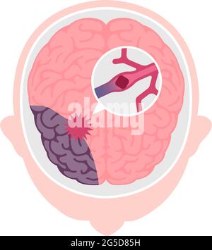Arten von Hirninfarkt-Vektor-Illustration Stock Vektor