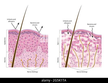 Normale und trockene Haut. Diagramm Stockfoto