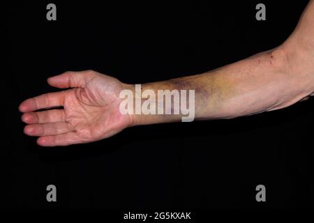 Patient mit Bluterguss, Hämatom, am rechten Arm, nach Einfügung eines Herzschrittmachers, Deutschland, Europa Stockfoto