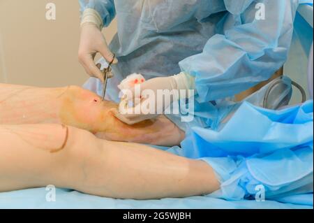 Kosmetische Chirurgie Fettabsaugung. Der Prozess der Beseitigung von Fett auf den Beinen einer fetten Frau. Ohne Gesicht, nicht erkennbarer Patient. Stockfoto