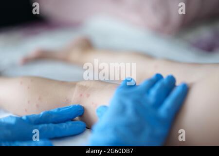 Arzt untersucht roten Ausschlag auf die Beine des Kindes in der Klinik Nahaufnahme Stockfoto