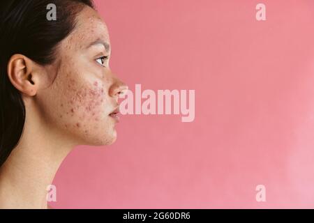 Seitenansicht Porträt einer Frau mit Akne-Entzündung. Nahaufnahme einer depressiven jungen Frau mit Hautproblemen auf rosa Hintergrund. Stockfoto