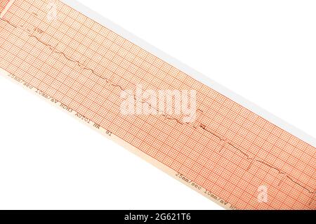 EKG-Testergebnisse auf Millimeterpapier, Herzrhythmus-Ergebnisse, Nahaufnahme der EKG-Diagrammdetails Stockfoto