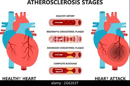 Stadien von Herzinfarkt und Atherosklerose. Gesunde und ungesunde Arterien. Cholesterin in den Blutgefäßen. Stock Vektor