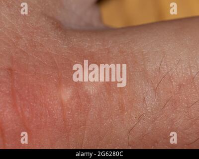 Narbe einer Warze am Zeigefinger Stockfoto