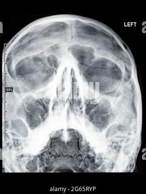 Radiographie eines menschlichen Schädels Paranasale Nasennebenhöhlen Rhinosinusitis diagnostische Sinusitis Röntgenstrahlen Stockfoto