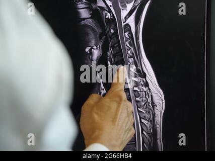 Arzt zeigt auf MRT der zervikalen Spondylose auf dem Computerbildschirm. Stockfoto