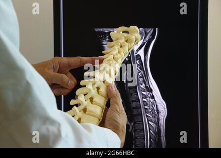 Arzt, der das Modell der Halswirbelsäule vor dem Computerbildschirm der MRT-Wirbelsäule hält Stockfoto