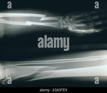 Radiographie. Medizinische Röntgenaufnahme von gebrochenem Bein und Arm. Stockfoto