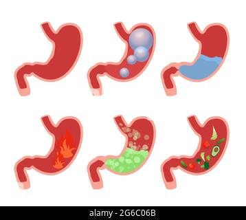 Vektor-Illustration Cartoon Satz medizinische Illustrationen von Bauch aufgeblähten Magen. Verschiedene Arten von Magenbeschwerden. Gas, Alkohol, Schwellungen Stock Vektor