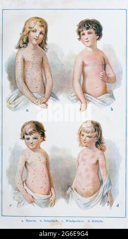 Die vier Kinderkrankheiten, Masern, Scharlach, Windpocken, Röteln, Der praktische Hausarzt, ein Weg zur Gesundheit, 1901, Breslau Stockfoto