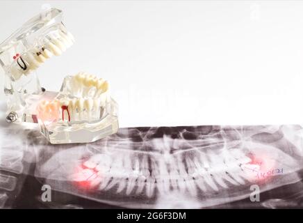 Beeinflusste Weisheitszähne auf einem Röntgenbild mit einem entzündeten Zysten-Neoplasma. Entfernung von Weisheitszähnen in der Zahnmedizin Stockfoto