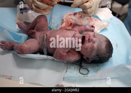 Maracaibo - Venezuela 19-06-2015 - Maternity Castillo Plaza in Venezuela. Eine Kindergeburt durch Neugeborene, die vom Gynäkologen überprüft wird. © JOSE ISAAC BULA Stockfoto