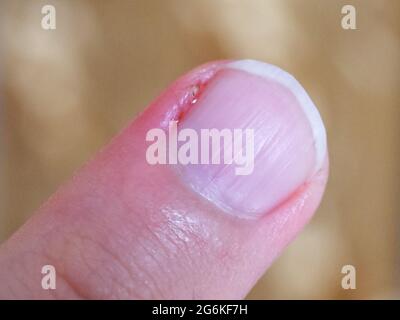 Entzündete Nagelhaut am Finger. Beschädigter Teil des Fingers, Nahaufnahme. Stockfoto