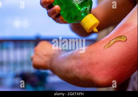 Anwendung von Aloe Vera Gel auf einen roten Sonnenbrand auf einem Arm  Stockfotografie - Alamy