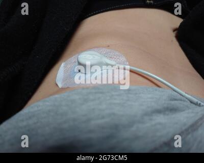 Nahaufnahme eines am Körper befestigten holter-Monitors für den ekg-Test Stockfoto