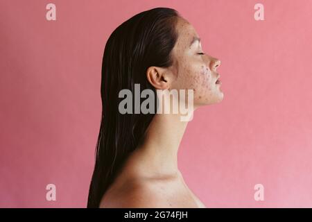 Seitenansicht Porträt einer Frau mit Akne-Entzündung auf rosa Hintergrund. Hauterkrankungen führen bei Frauen zu Depressionen und Unsicherheiten. Stockfoto