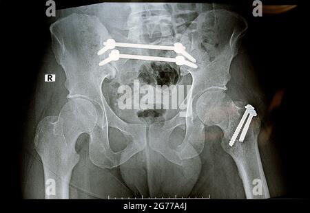 Einfaches Röntgenbild mit einem Frakturbecken, das mit 4 Schrauben und 2 Stäben befestigt ist, und Bruch eines größeren Trochanters des Oberschenkels, der mit 2 Schrauben befestigt ist Stockfoto