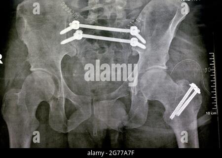 Einfaches Röntgenbild mit einem Frakturbecken, das mit 4 Schrauben und 2 Stäben befestigt ist, und Bruch eines größeren Trochanters des Oberschenkels, der mit 2 Schrauben befestigt ist Stockfoto