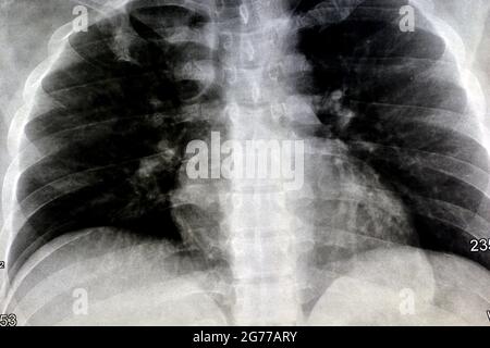 Normale Röntgenaufnahme der Brust, fast normale menschliche Röntgenaufnahme der Brust, aber mit einigen Staus, die durch Rauchen und chronische Bronchitis entstanden sind, liegt der Herzschatten innerhalb von norma Stockfoto